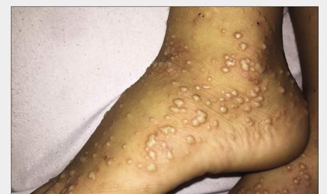 常见的传染性皮肤病（了解哪些皮肤病容易传染，保护自己和他人）